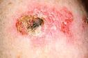  عقار هو الأول من نوعه لعلاج شكل من أشكال سرطان الجلد