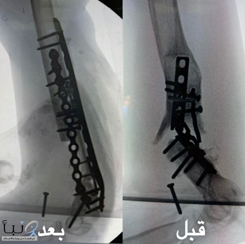 “سعود الطبية” تعيد الحركة لمفصل كوع مريض بعد 10 أعوام من العجز