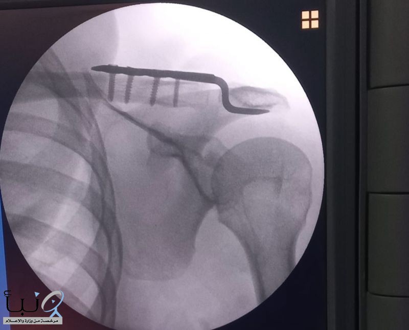 نجاح أول عملية نوعية لخلع المفصل الأخرمي الترقوي بمستشفى القويعية