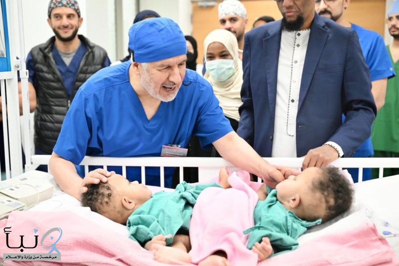 نجاح فصل التوأم الملتصق الصومالي “رحمة و رملا” بعد عملية جراحية معقدة استغرقت 12 ساعة
