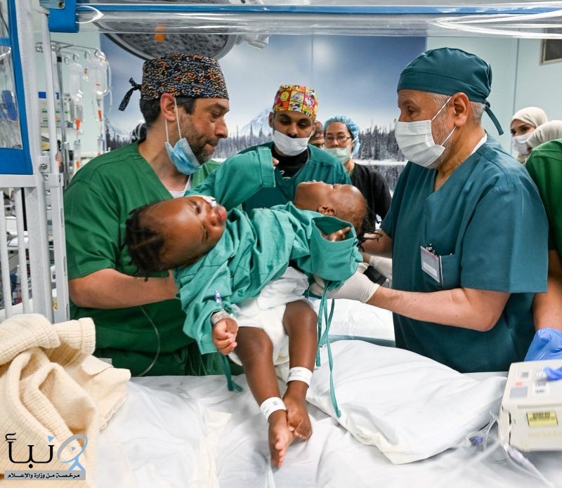 إنفاذًا لتوجيهات خادم الحرمين الشريفين وسمو ولي العهد.. بدء عملية فصل التوأم الملتصق التنزاني (نانسي ونايس)
