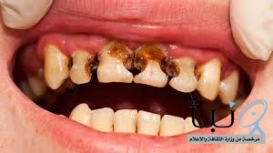 96 % من أطفال المملكة مصابون بـ"تسوس الأسنان"