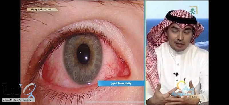 استشاري طب عيون يحذِّر: "السويرق" يخطف البصر دون أعراض