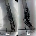 “سعود الطبية” تعيد الحركة لمفصل كوع مريض بعد 10 أعوام من العجز